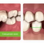 displacement of teeth after extraction