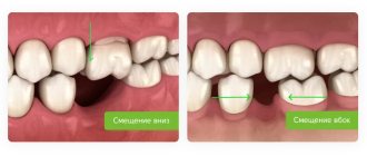 displacement of teeth after extraction