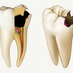 ways to treat pulpitis at home