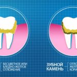 Comparative characteristics of plaque and stone