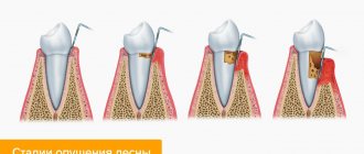 Stages of receding gums in pictures