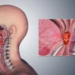 Stages of throat cancer (larynx)