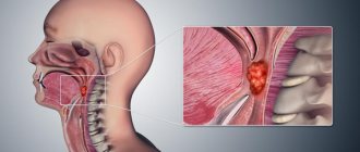 Stages of throat cancer (larynx)