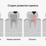 Stages of caries development in pictures