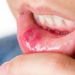 stomatitis in children