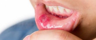 stomatitis in children