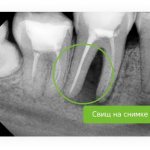 dental fistula on x-ray