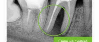 свищ зуба на рентгене