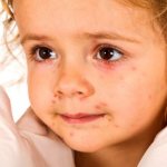 Rash around a child&#39;s mouth. Causes 2-3, 5-6 years, how to treat, what Komarovsky advises 