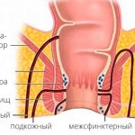 Типы свищей прямой кишки