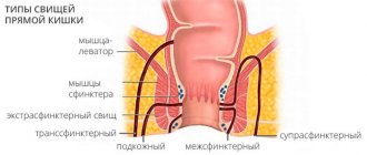 Типы свищей прямой кишки