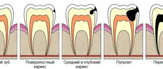 nerve removal