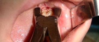удаление нижнего зуба