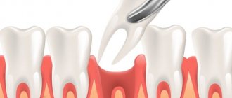 Removal of a tooth