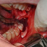 Wisdom tooth removal