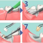 wisdom tooth removal