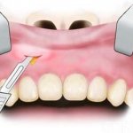 Tooth extraction due to inflammation