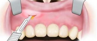 Tooth extraction due to inflammation