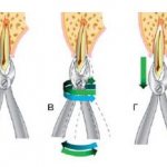 Removal of a tooth