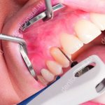 Ultrasonic cleaning Vector for periodontitis