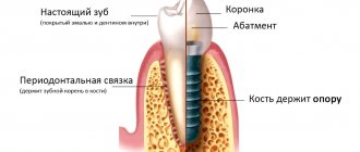 Installation of implants step by step