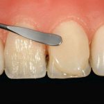 installation of direct veneers