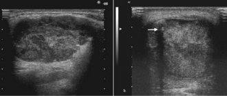 ultrasound of the salivary glands