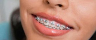 at what age is it better to get braces?