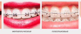 Types of braces