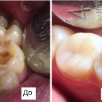 Types of artistic restoration