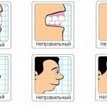 Types of bite