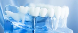 Виды зубных протезов с опорой на импланты