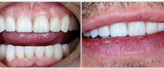 veneers contraindications for use