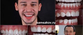 Vitaly’s veneers look great after installation!