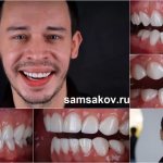 Виниры у Виталия после установки смотрятся суперски!