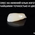 Вкладка cerec на нижний клык. Автор - Сергей Самсаков, ортопед стоматологического центра CERECON, Москва