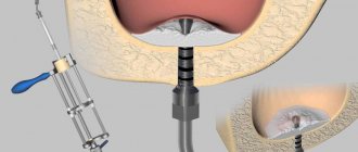 Replenishment of bone tissue deficiency in the area of ​​the anterior chewing teeth