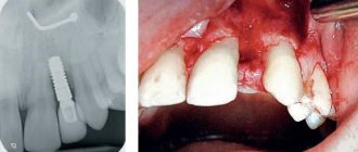 Restoration of a maxillary lateral incisor affected by aplasia