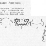 Воздействие активатора Андрезена-Гойпля на зубы