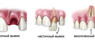 Tooth luxation