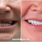 Due to the fact that we remove wear on the lower teeth, people change. How do they change? - they, as a rule, begin to take care of themselves more, they see how they look younger, how their face has changed 