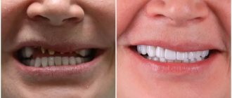 За счет того, что убираем стираемость нижних зубов, люди - меняются. Как меняются? - они, как правило, начинают собой заниматься больше, они видят как они помолодели, как изменилось их лицо