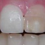 здоровые зубы без боли