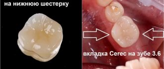 Зуб 6 был восстановлен буквально из одного корня за 1,5 часа по технологии Cerec