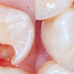 Tooth before and after filling