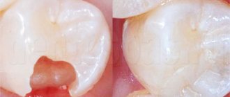 Tooth before and after filling