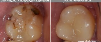 зуб мудрости до и после лечения