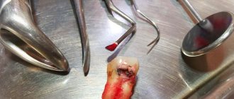 Dental pulpitis