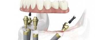 dental implants