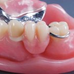 Dentures made of acrylic plastic. Advantages and disadvantages 